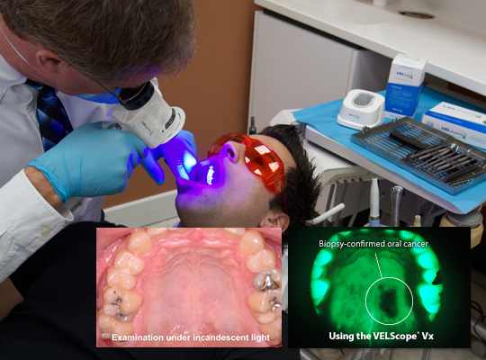 Velscope Technology - dental cone beam scan